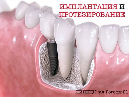 Имплантация и протезирование